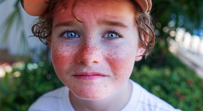 Wat doen bij zonnebrand